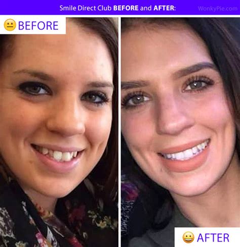 smile direct results|smile direct before and after.